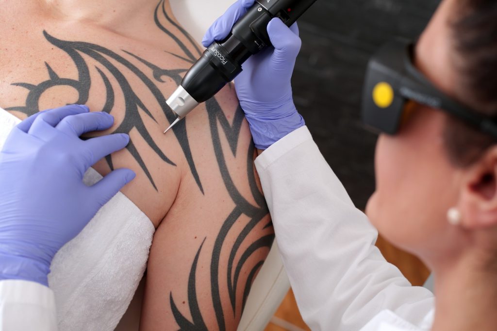 Tattoo Cares Laser Removal