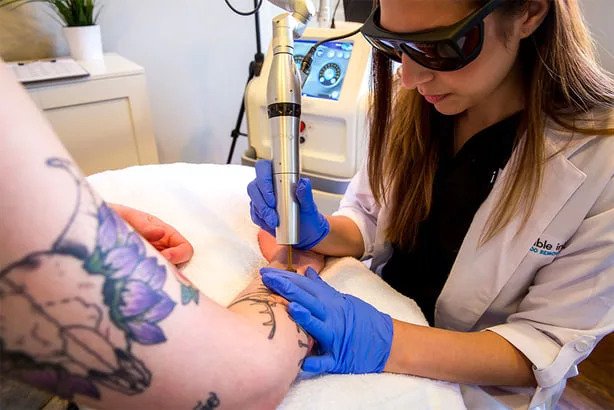 Tattoo Removal Cost Factors